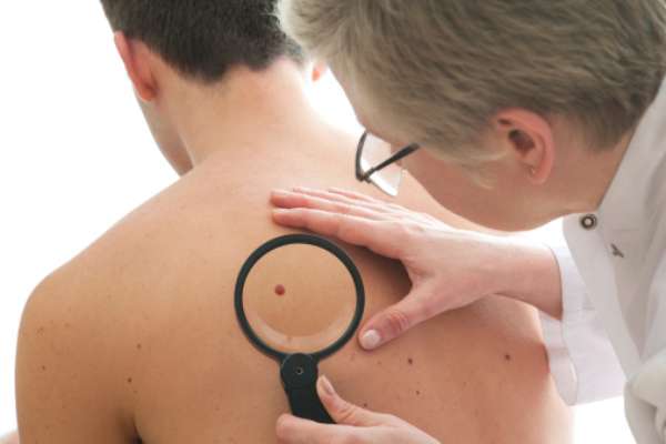 Lunares rojos en la piel: ¿A qué se deben y cómo podemos prevenirlos?